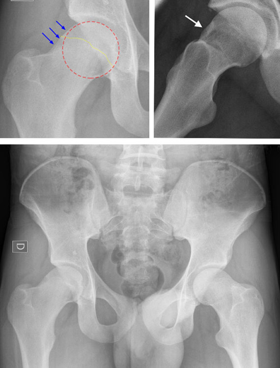 Potter Hip Impingement Test